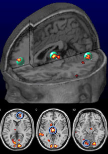 Именно те три зоны головного мозга (средняя префронтальная кора, таламус и мозжечок), связь которых с шизофренией удалось установить ранее, показывают значительную активацию у здоровых добровольцев, решающих, были ли стимулы реальными или только предполагаемыми. Изображение из статьи с сайта www.cus.cam.ac.uk/~jss30/