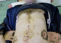 Дмитрий Крутов после операции. Фото: pytkam.net