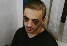 Абдулмалик Албагачиев после пыток. Источник: zona.media