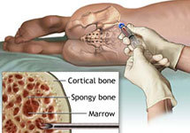 Изображение с сайта health.allrefer.com/health/bone-marrow-transplant-bone-marrow-aspiration.html