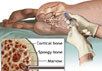 Изображение с сайта health.allrefer.com/health/bone-marrow-transplant-bone-marrow-aspiration.html