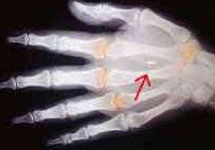 Рука мертвеца с вживленным чипом. Фото с сайта www.tldm.org