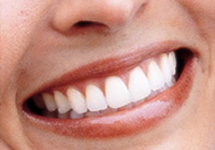 tooth-whitening-melbourne