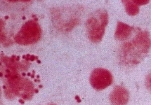 Энтеровирусная инфекция. Фото: meduniver.com