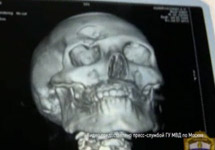 Рентгеновский снимок черепа избитого полицейского. Кадр видеохроники пресс-службы ГУ МВД Москвы
