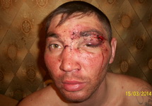Дмитрий Пахомов после избиения. Фото: pytkam.net