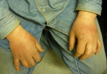 Руки Сергея Лялина после пыток током. Фото супруги потерпевшего с pytkam.net
