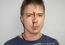 Станислав Калиниченко после избиения полицейскими. Фото из личного блога на newkuzbass.ru